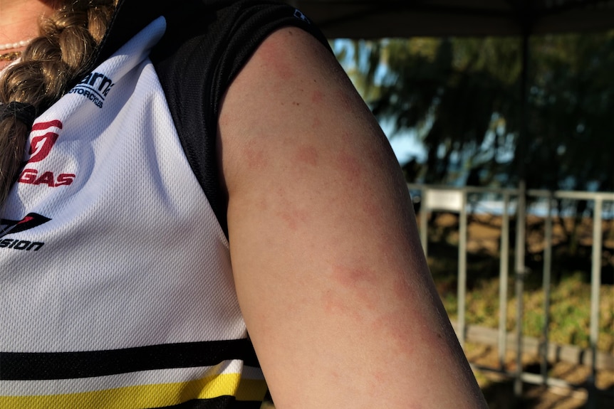Red welts on a girl's arm. 