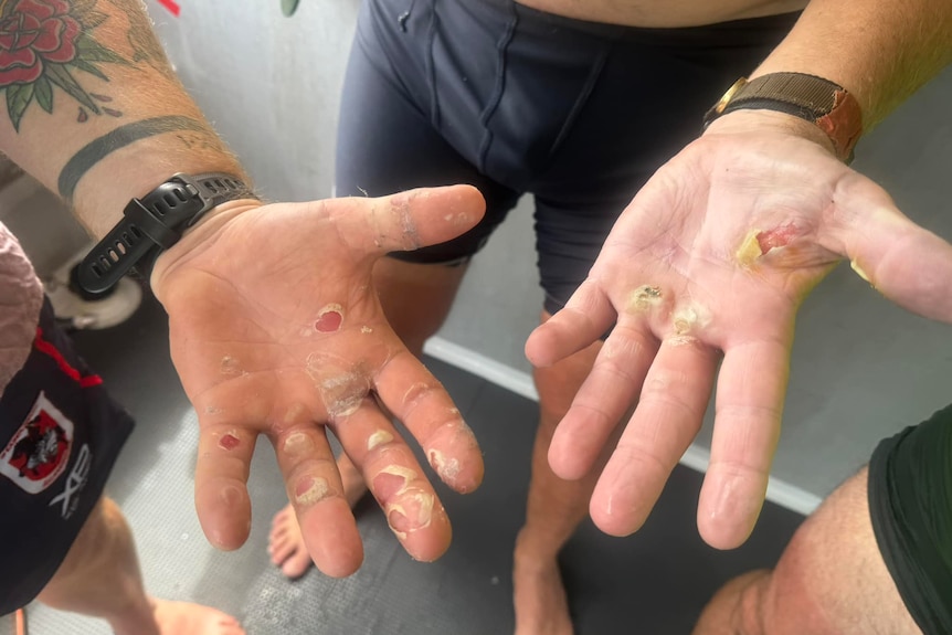 A close up of two men's hands with some serious blisters.