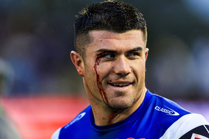 Bradman Best smiles with blood coming from his eye