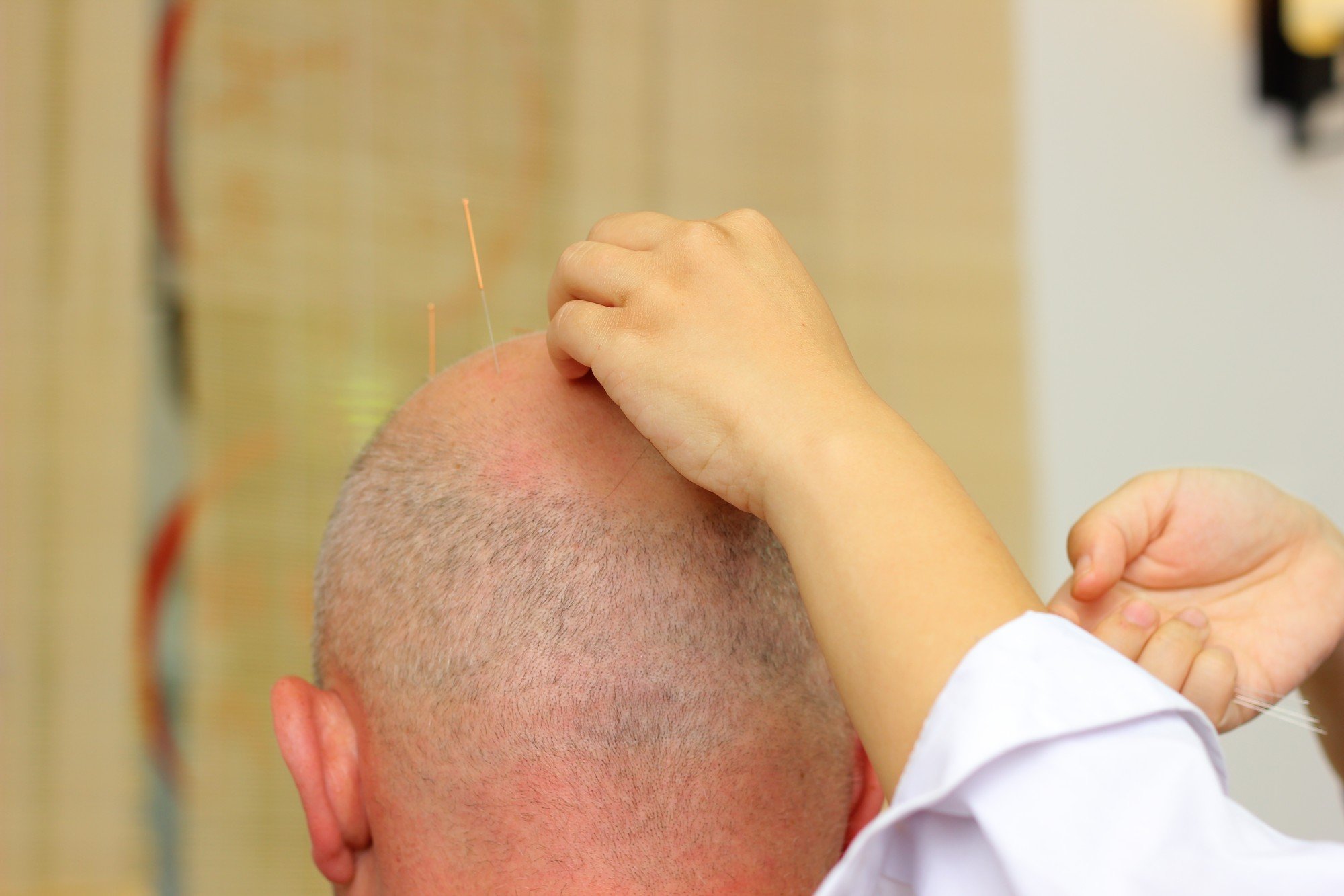 The procedure involves sticking needles into the head at special points. Photo: Shutterstock