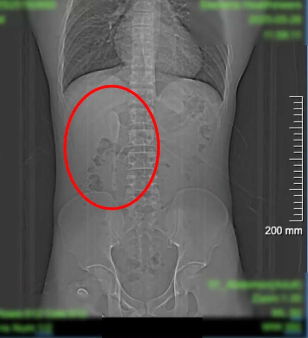 The spoon became lodged in his duodenum, the initial section of the small intestine. Photo: QQ.com The spoon became lodged in his duodenum, the initial section of the small intestine. Photo: QQ.com