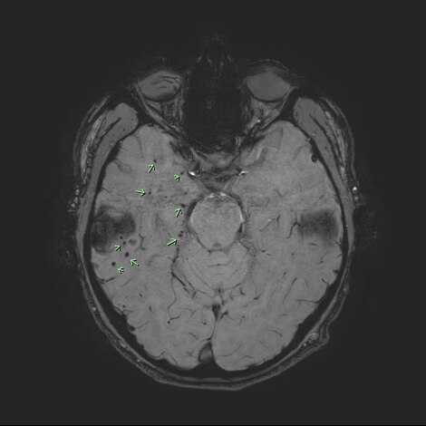 A brain scan with eight arrows pointing to brain bleeds.