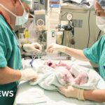 One in four births in England is now emergency caesarean, BBC analysis shows